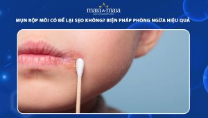 mụn rộp môi có để lại sẹo không