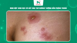 mụn rộp sinh dục có gây ung thư không