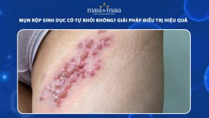 mụn rộp sinh dục có tự khỏi không