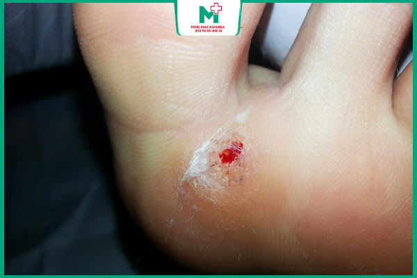 nốt mụn cóc rỉ máu