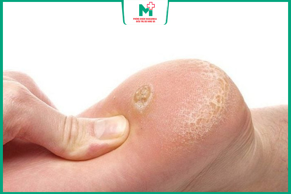 tiếp xúc trực tiếp với mụn cóc