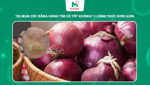 trị mụn cóc bằng hành tím
