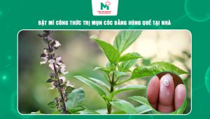 trị mụn cóc bằng húng quế