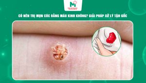 trị mụn cóc bằng máu kinh