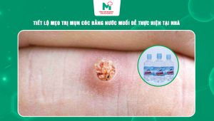 trị mụn cóc bằng nước muối