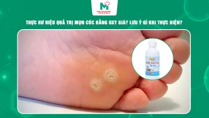 trị mụn cóc bằng oxy già