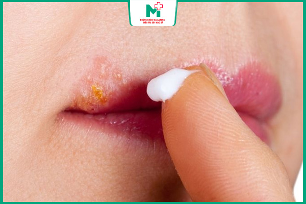 bôi thuốc trị mụn rộp miệng