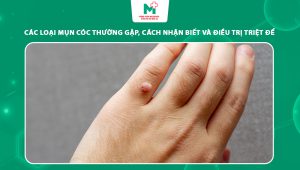 các loại mụn cóc