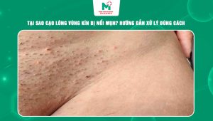 cạo lông vùng kín bị nổi mụn