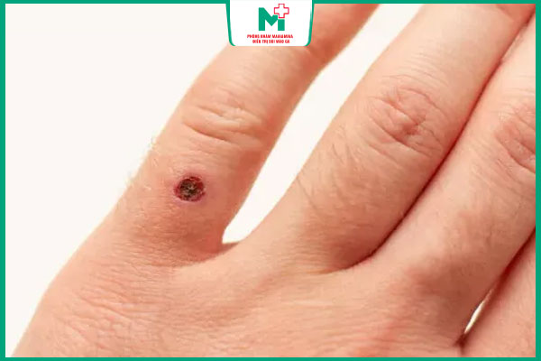 chảy máu sau khi đốt mụn cóc