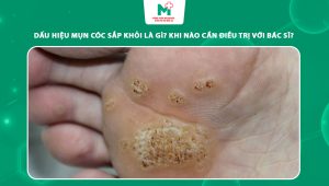dấu hiệu mụn cóc sắp khỏi