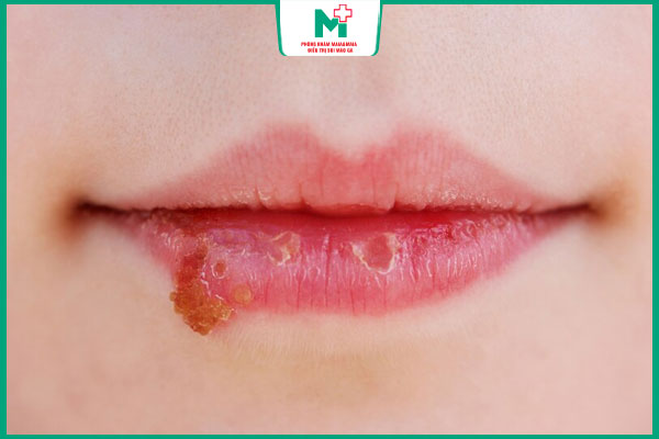 dấu hiệu mụn rộp ở môi