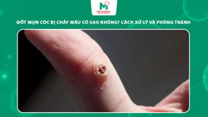 đốt mụn cóc bị chảy máu