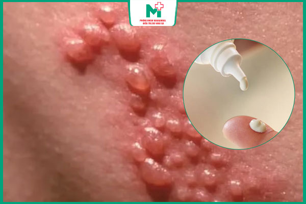 hiệu quả thuốc bôi trị mụn rộp sinh dục