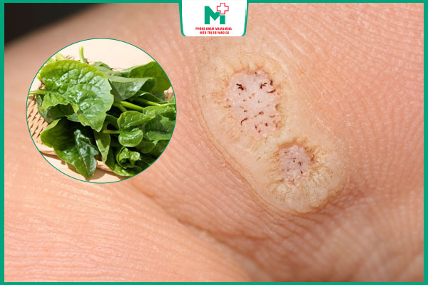 hiệu quả trị mụn cóc bằng mồng tơi