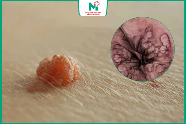 hình ảnh mụn cóc hậu môn