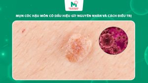 mụn cóc hậu môn