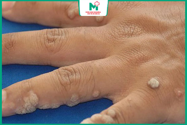 mụn cóc lan rộng