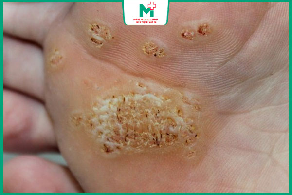 mụn cóc thể khảm