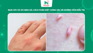 mụn cóc và sùi mào gà