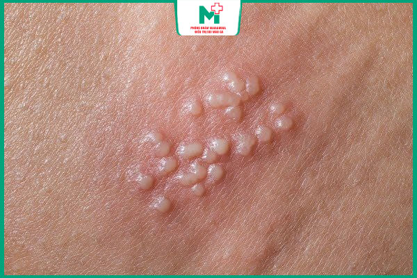 mụn rộp mọc cụm