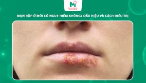 mụn rộp ở môi