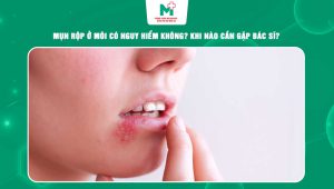 mụn rộp ở môi có nguy hiểm không