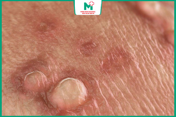 mụn rộp sinh dục có mủ