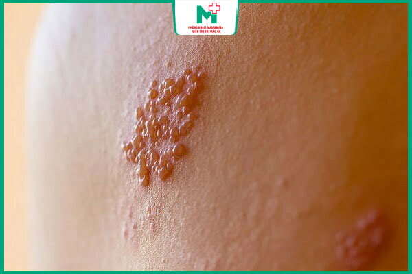mụn rộp sinh dục lan rộng