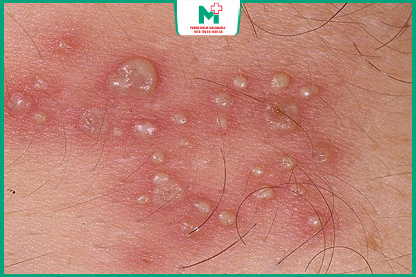 mụn rộp sinh dục