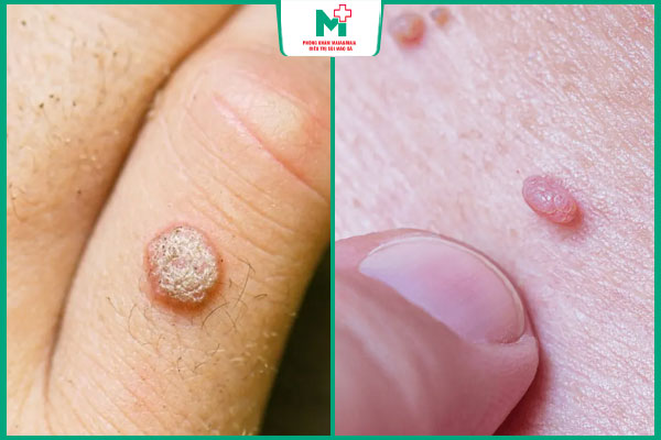 phân biệt mụn cóc và sùi mào gà