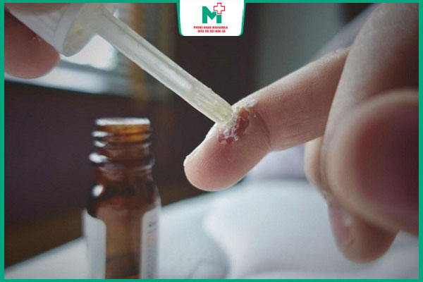 thuốc xóa mụn cóc