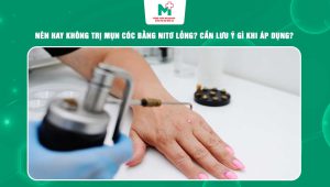 trị mụn cóc bằng nitơ lỏng