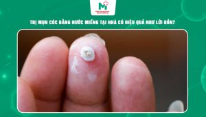 trị mụn cóc bằng nước miếng
