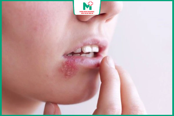 triệu chứng mụn rộp sinh dục ở miệng