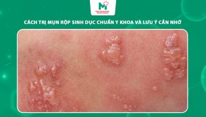 cách trị mụn rộp sinh dục