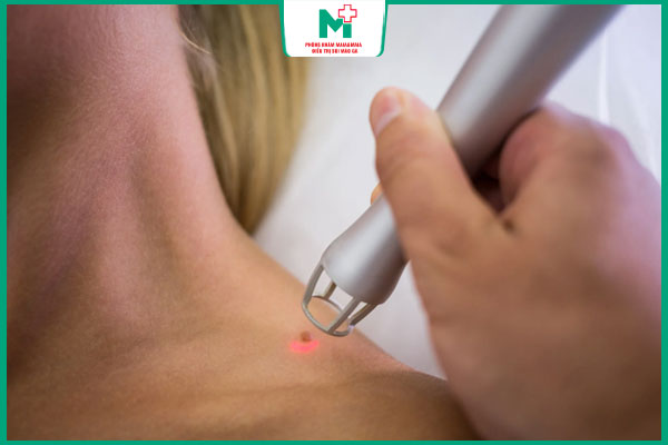 đốt mụn cóc ở cổ