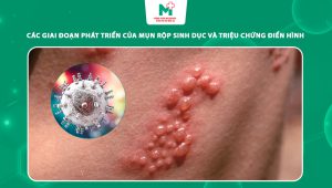 giai đoạn phát triển của mụn rộp sinh dục