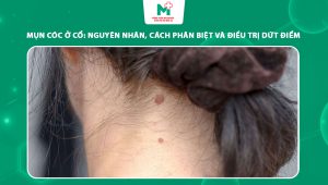 mụn cóc ở cổ
