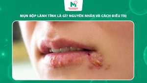 mụn rộp lành tính