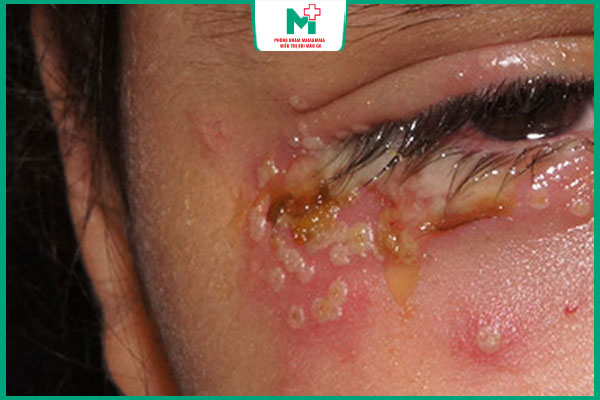 mụn rộp mắt nguy hiểm