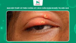mụn rộp ở mắt