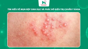 mụn rộp sinh dục