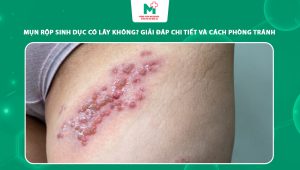 mụn rộp sinh dục có lây không