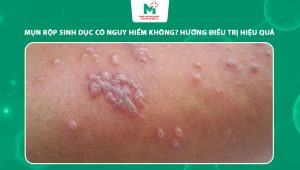 mụn rộp sinh dục có nguy hiểm không