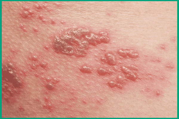 mụn rộp sinh dục lan rộng