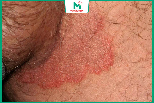 mụn rộp sinh dục sơ nhiễm