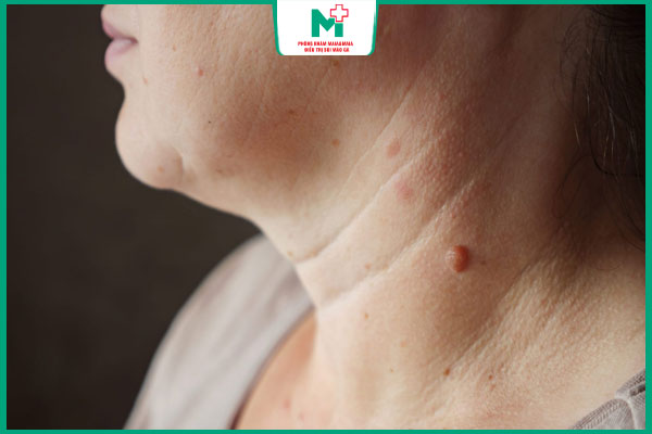 nổi mụn cóc ở cổ