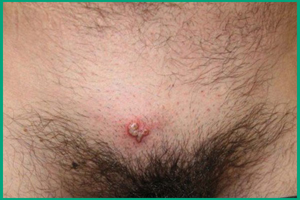 nổi mụn rộp sinh dục