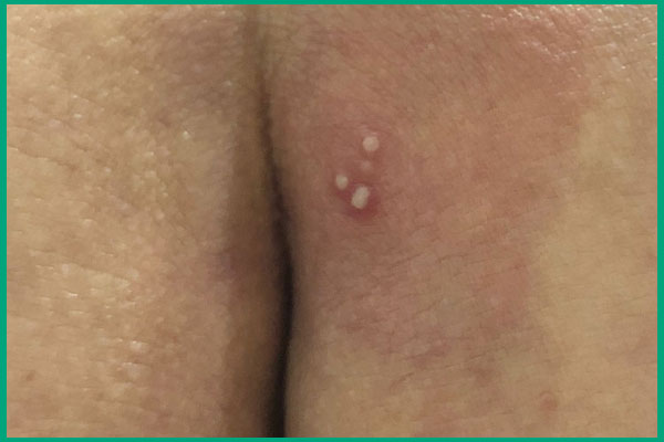 nốt mụn rộp sinh dục